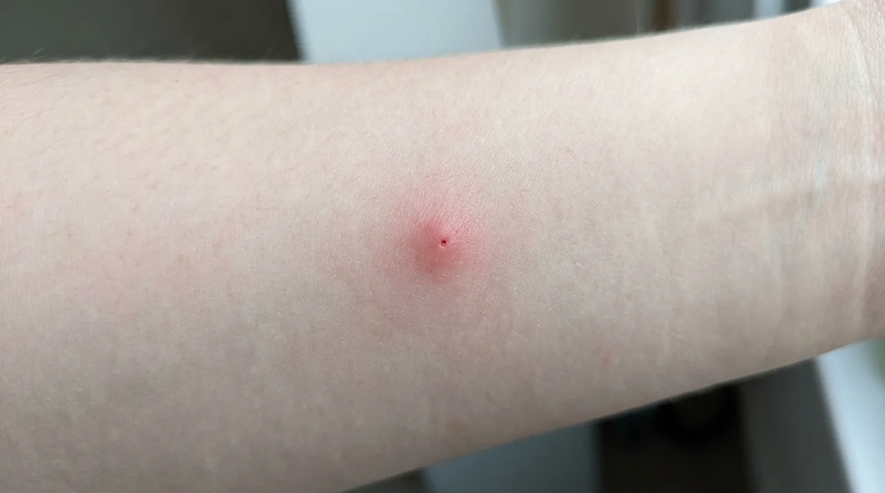 What do spider bites look like? What do spider bites look like?