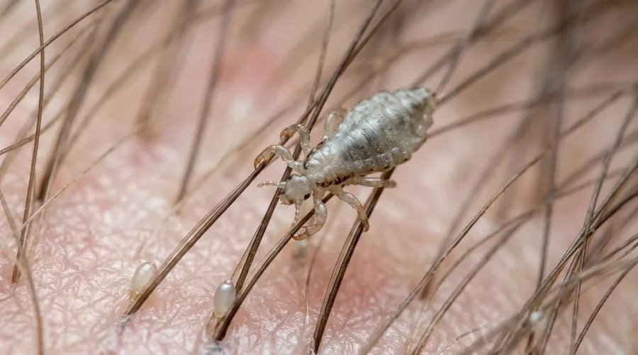 Tan head louse gripping a strand of human hair near the scalp